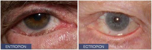 (away from the globe; ectropion) Fig 24: Entropion and ectropion Causes: most cases are involutional (age-related) or cicatricial.