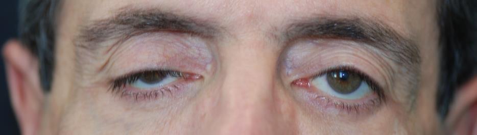 Fig 7: Ptosis (above) and lid retraction (below) On the other hand failure of the eyelid to close, generally because of 7 th nerve palsy is called Lagophthalmos and could easily result in corneal