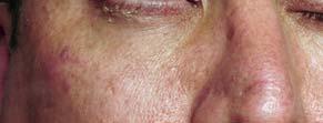 conjunctivitis Patching or
