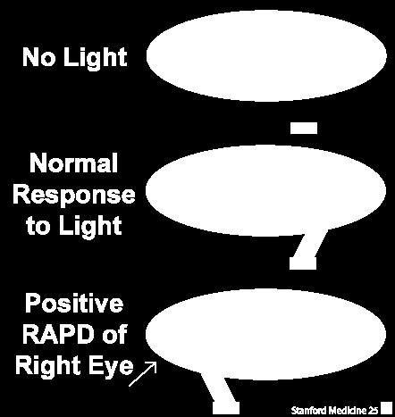 When no light is present, both pupils are dilated Presenting light in one eye will result in similar constriction in