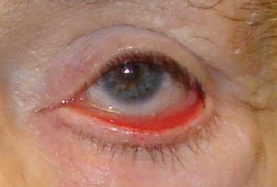 Ectropion Edges of the eyelid roll out due to: Trauma