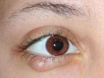 Chalazion is a painless cyst in the eyelid due to blocked