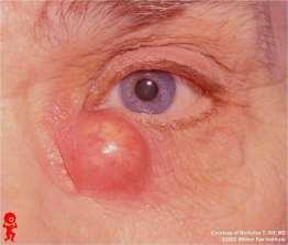 Inflammation and/or infection of the lacrimal sac 2/2 obstruction of duct Usually Staph aureus, Strep, Staph