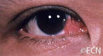 nasal side Encroaches on the cornea Leave alone