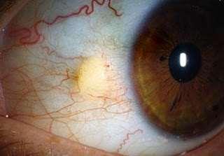Elevated yellow mass on the conjunctiva,