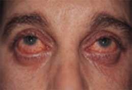 Cobblestoning of palpebral surfaces Associated with other allergic