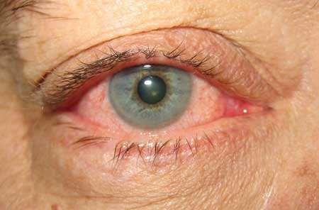 Caused by adenovirus Very contagious Unilateral or bilateral Often starts