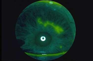 Dendritic ulcers on cornea observed on