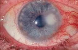 Ulcers involve the epithelium and stroma Can be caused by: Trauma Infection Contact lenses SX: Pain, photophobia, tearing