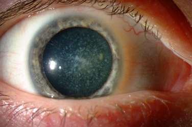 diabetes, systemic steroids Signs: lens appears