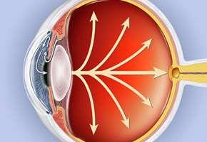 Increased intraocular pressure (IOP 20) due to