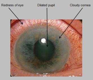 Closed angle glaucoma is an EMERGENCY S/SX: painful red eye, fixed/mid-dilated pupil, vision loss,