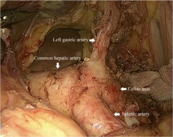 With endoscopic linear staplers (Endocutter 60 staple; Ethicon Endo- Surgery, Inc, Cincinnati, OH), both input and output jejunal loops were transected at a point 5 cm distal to the anastomotic site.