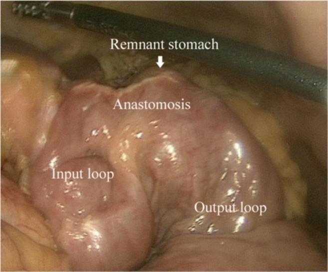 An intracorporeal esophagojejunostomy was performed using endoscopic linear staplers.