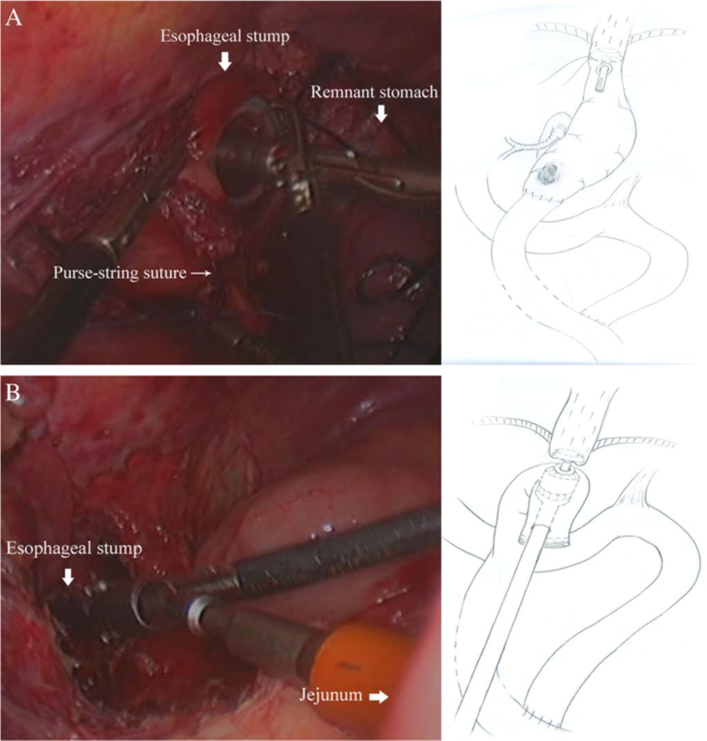 Pan et al. World Journal of Surgical Oncology 2014, 12:342 Page 4 of 6 Figure 5 End-to-side intracorporeal esophagojejunostomy. A.