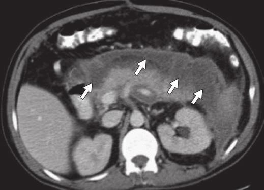 pancreatitis. early phase of acute pancreatitis is largely based on clinical parameters, but imaging is particularly important to guide treatment of acute pancreatitis during the late phase.
