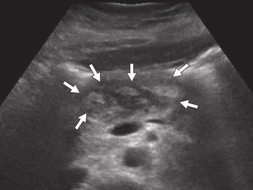 Ultrasound and MRI are adjuncts to CT in the appraisal and management of acute pancreatitis.