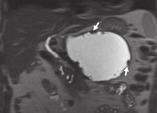 severity of acute pancreatitis appears moderate or severe or necrosis is suspected.