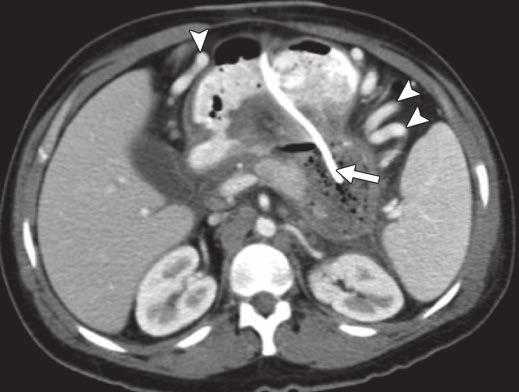 tail (arrow). Further WON is seen posterior to left kidney (arrowhead) that does not contain gas pockets. prognostic significance.