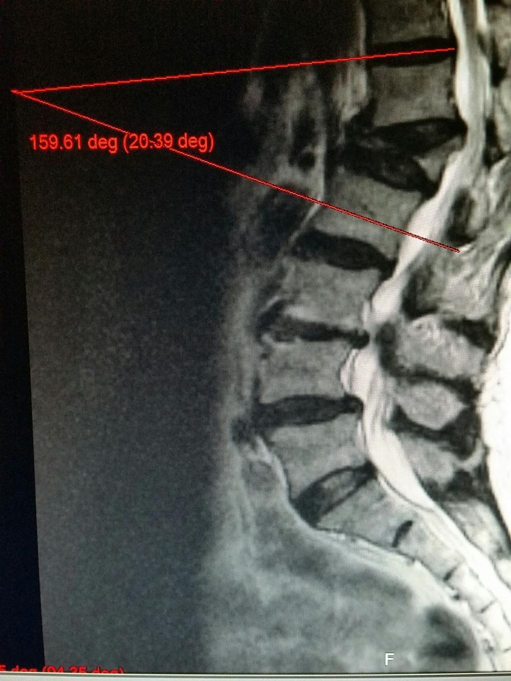 FIGURE 1: MRI sagittal view demonstrating kyphotic angulation after progressive collapse of an untreated vertebral compression fracture There is recent literature suggesting vertebral augmentation or