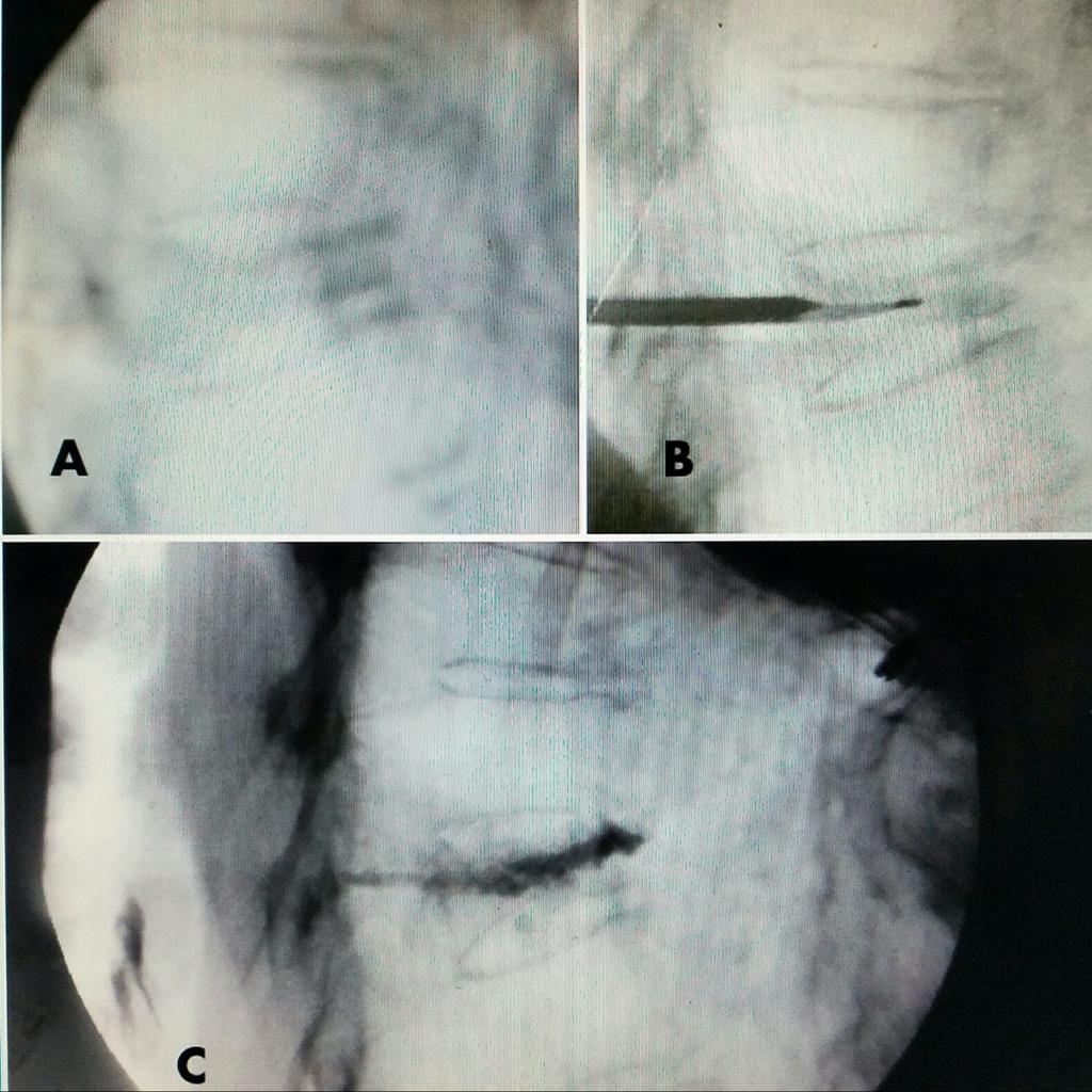 FIGURE 3: Pre and post-injection films A: T8 vertebra plana. B: Single cannula and dissecting curette slightly superior creating cavity.