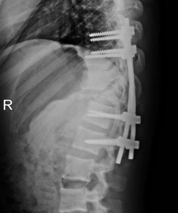 The screws are tightened in compression in order to build up a firm contact between inferior aspect of T11 vertebral body and the remaining one