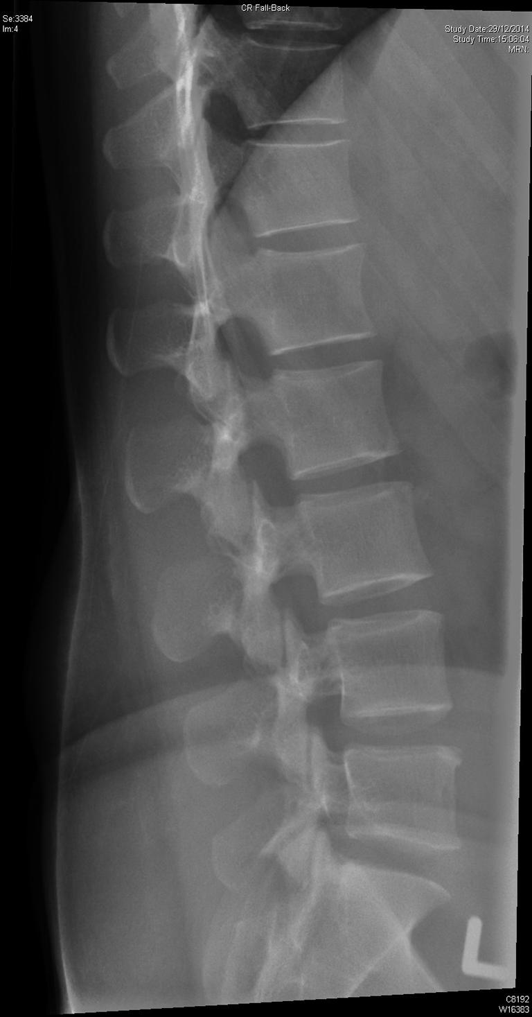 Scheuermann s disease Scheuermann s disease is an uncommon thoracolumbar spinal disorder characterized by endplate indentations, reduced disc height, reduced vertebral height, increased vertebral