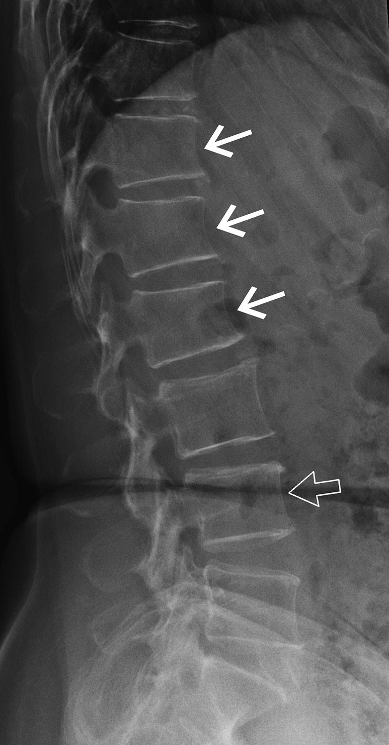 596 Griffith. Identifying osteoporotic vertebral fracture Figure 3 Difficult call.