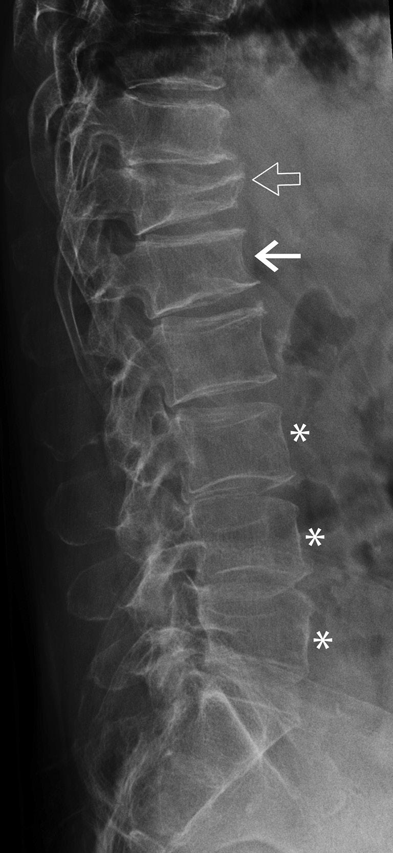 Quantitative Imaging in Medicine and Surgery, Vol 5, No 4 August 2015 597 Figure 6 There is a severe osteoporotic fracture of the T12 vertebral body (open arrow) with a mild osteoporotic fracture of