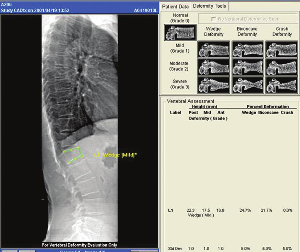 600 Griffith. Identifying osteoporotic vertebral fracture Figure 10 Vertebral fracture assessment by DXA showing mild fracture of L1 vertebral body. DXA, dual energy X-ray absorptiometry.