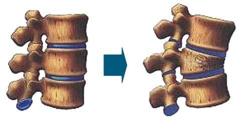 Vertebral Body Compression Fractures Osteoporotic vertebral compression fractures (OVCFs) are the most common