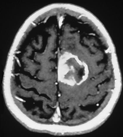 Glioblastoma Multiforme Highly malignant, invasive, difficult-to-treat primary brain tumor" " Frequency: 9,000