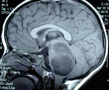 Pediatric brainstem glioma" Brainstem location