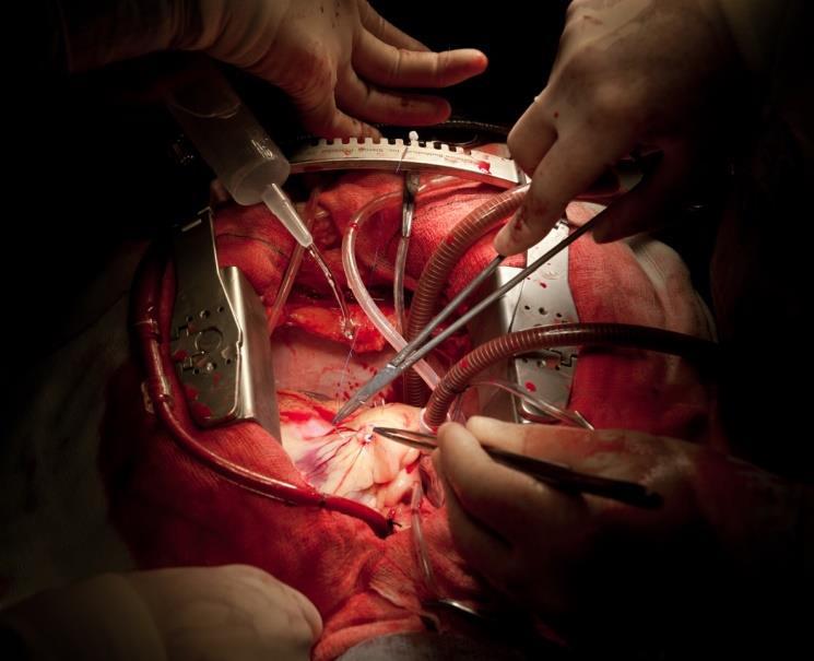 Severe Inflammation is Dangerous in Open Heart Surgery ~1 million Open Heart Surgeries in US and EU annually Coronary artery bypass graft surgery Valve repair or replacement Heart or lung