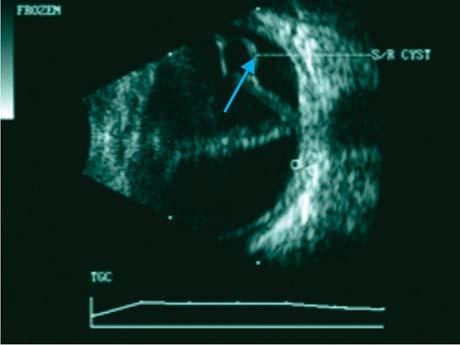 Diagnostics: Ultrasound B-Scan for Posterior Segment Evaluation Figure 7 (a&b) Figure 8: of posture