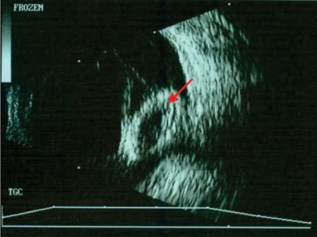 Diagnostics: Ultrasound B-Scan for