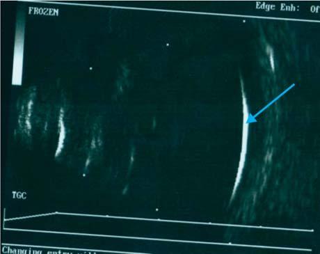 The silicone oil meniscus is seen as a high Pthisis bulbi: The ultrasound shows disorganised globe structures with reduced axial length.