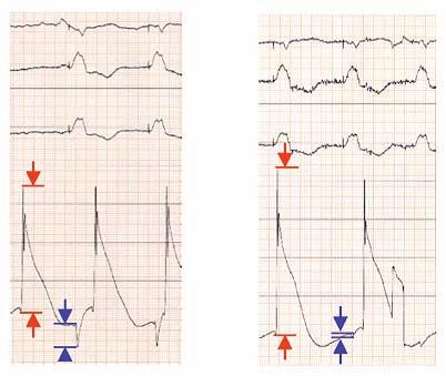 n Lead Pacing Impedance: Lead impedance, an indicator of how current travels through the lead, is a combination of the resistance within the lead itself and the impedance at the lead-tissue interface.