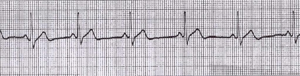 Sinus Arrhythmia Rate : Usually 60-100 beats/min but may be faster or slower Rhythm : IRREGULAR P