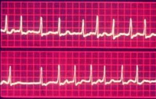 Fibrillation With Slow Ventricular Response