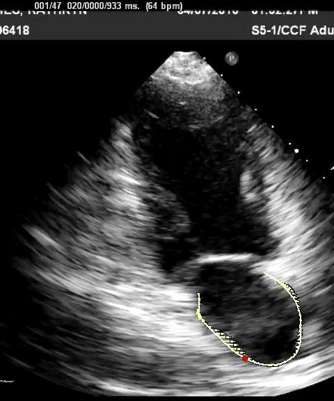 Speckle Tracking for Left Atrial Strain 498 Patients with