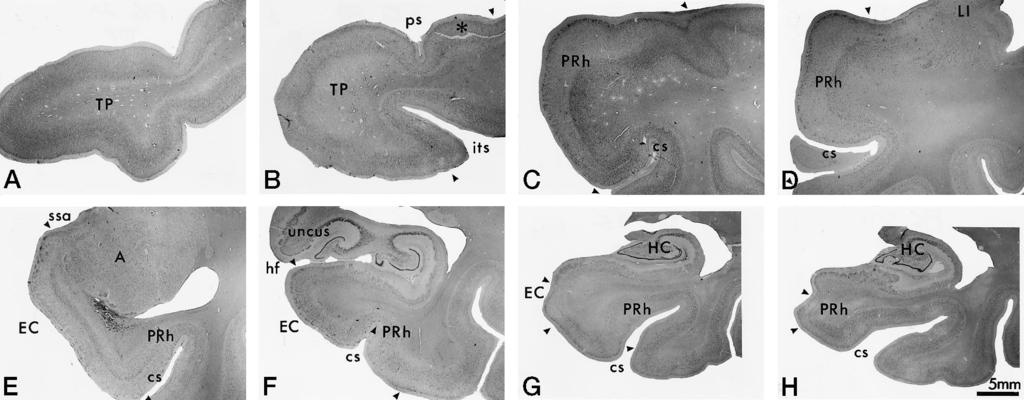individuals: A, 47-year-old man; B, 41-year-old woman; C F, 65-year-old man; G and H, 78-year-old man. Note that in E the collateral sulcus is regular and in F it is shallow.