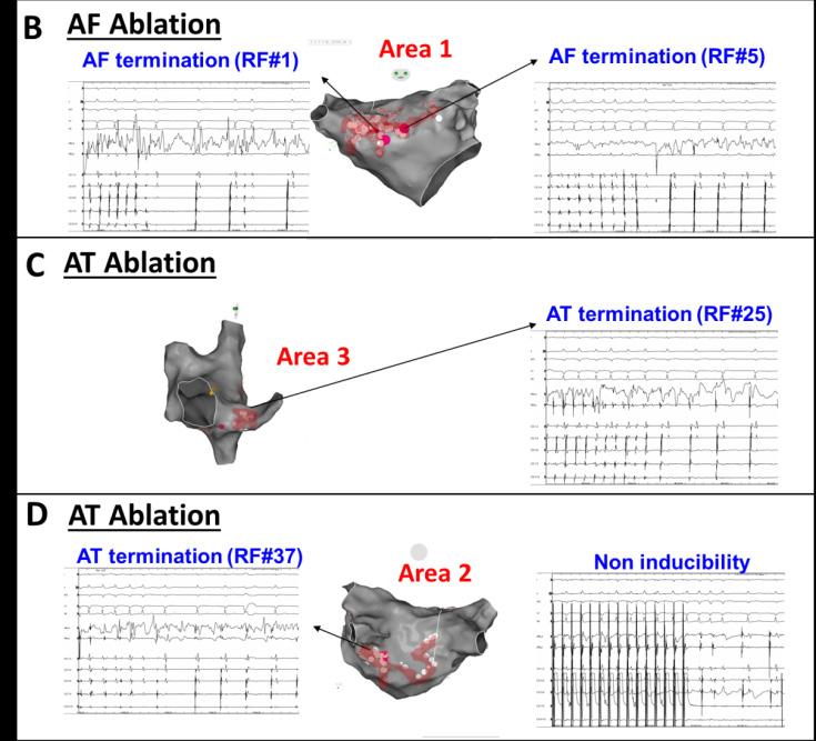Analysis in 21 patients: 44 ATs, 22 macroreentries & 22 localized AT (88,6% in non- ablated areas).