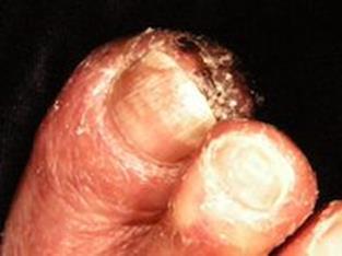 Acral lentiginus melanma (ALM) accunts fr abut 5% f melanma cases, and is a leading cause f skin cancer deaths. The disease initially appears as a bruise r nail streak n the skin.