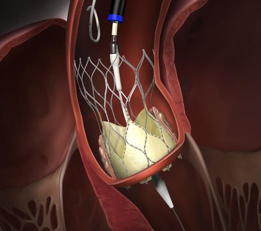 annulus Minimal protrusion of valve into LVOT Portico Transcatheter Aortic Valve Implantation System take aim with portico predictability The large cells in the annulus section of the stent are