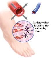 Oedema CCB dilates arteries Veins remain constricted ARB
