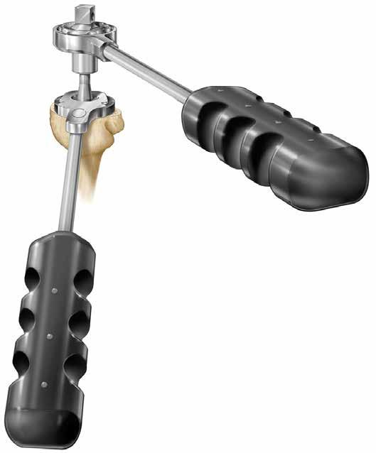 The Humeral Stem Trial can now be inserted using the Primary Stem Inserter (Figure 8a).