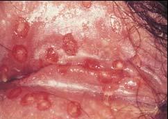 Genital herpes is a sexually transmitted disease caused by a herpes virus.