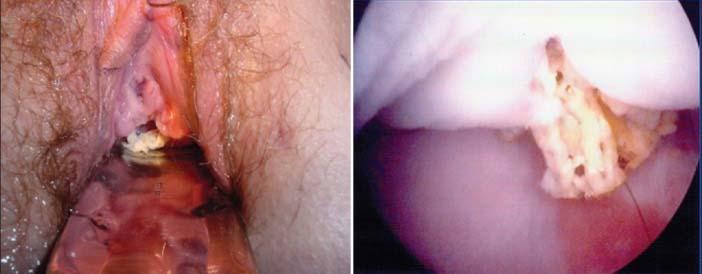 Vaginal Mesh Extrusion Vaginal inspection Vaginal