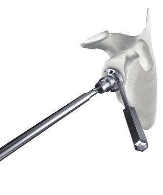 According to surgeon preference, exposure and surgical approach, one of the two handles is selected and assembled to the 6 mm drill guide.